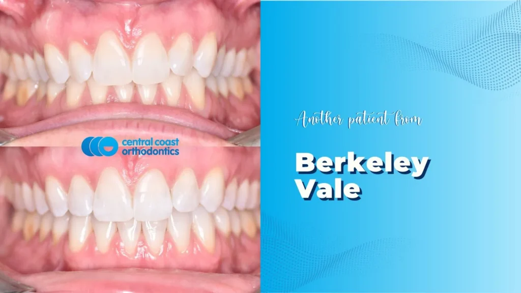 Before and after photographs of a Central Coast Orthodontics patient's teeth, labelled Berkeley Vale