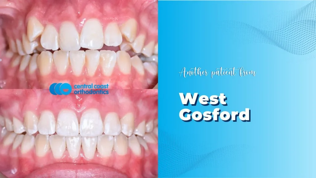Before and after photographs of a Central Coast Orthodontics patient's teeth, labelled West Gosford