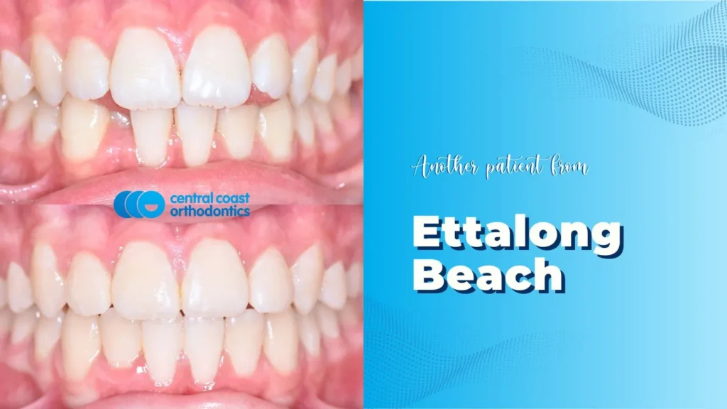 Before and after photographs of a Central Coast Orthodontics patient's teeth, labelled Ettalong Beach