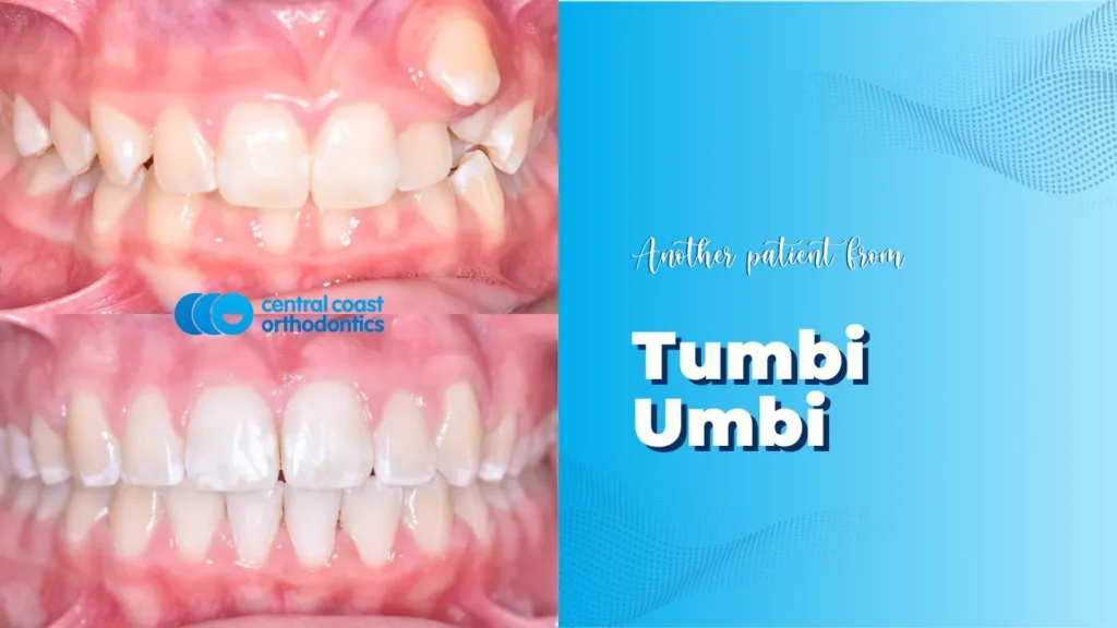 Before and after photographs of a Central Coast Orthodontics patient's teeth, labelled Tumbi Umbi