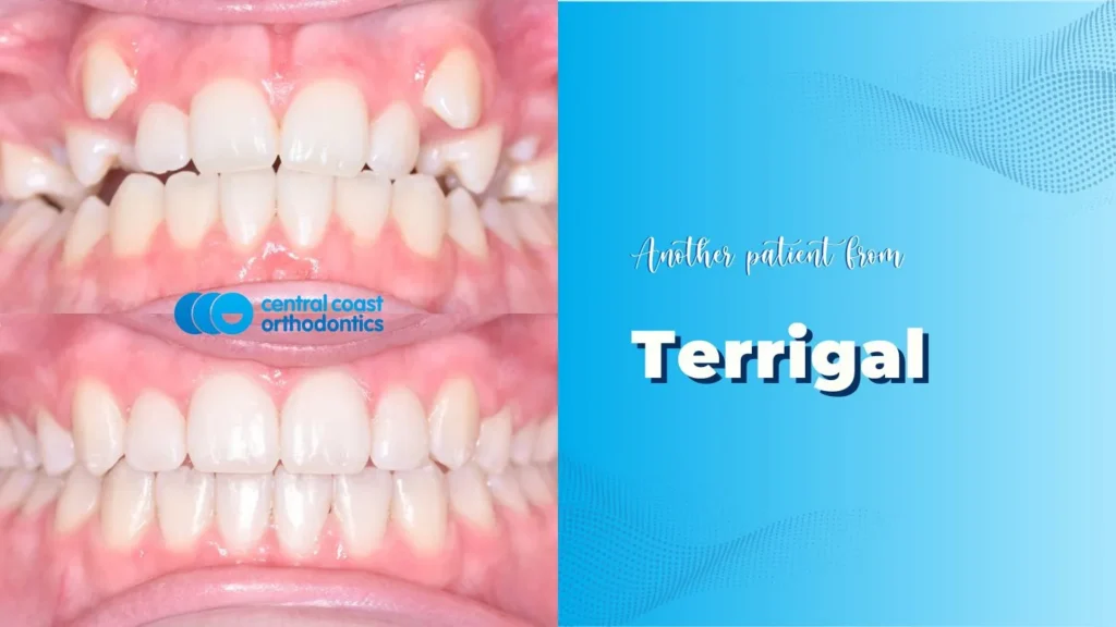 Before and after photographs of a Central Coast Orthodontics patient's teeth, labelled Terrigal