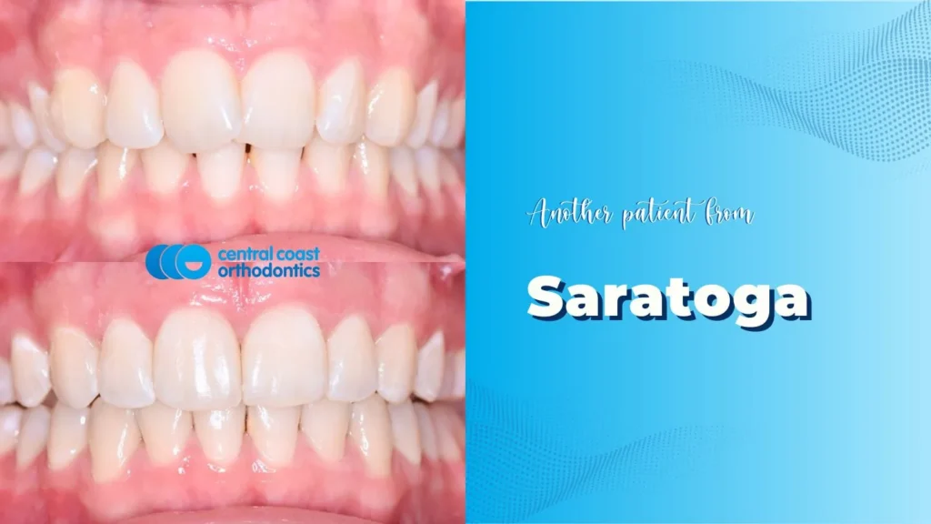 Before and after photographs of a Central Coast Orthodontics patient's teeth, labelled Saratoga