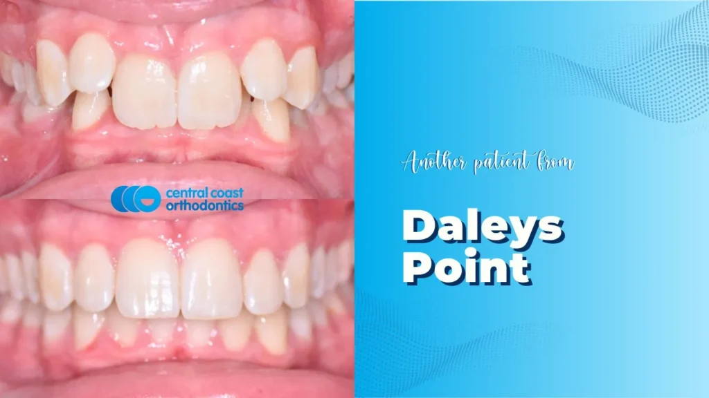 Before and after photographs of a Central Coast Orthodontics patient's teeth, labelled Daleys Point