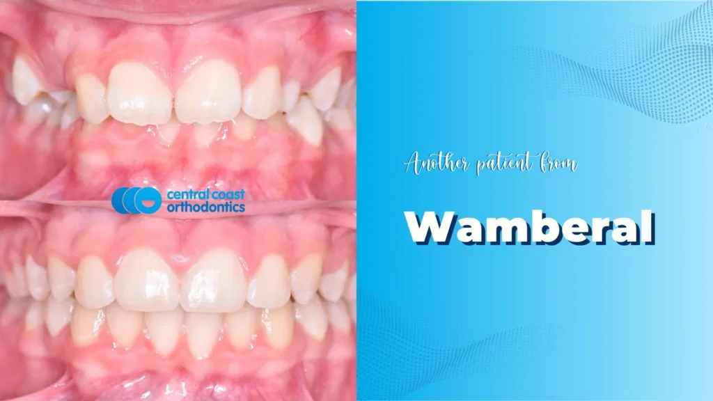Before and after photographs of a Central Coast Orthodontics patient's teeth, labelled Wamberal