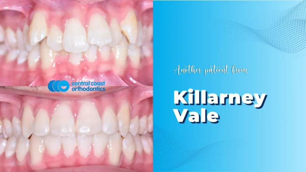 Before and after photographs of a Central Coast Orthodontics patient's teeth, labelled Killarney Vale
