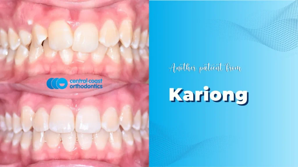 Before and after photographs of a Central Coast Orthodontics patient's teeth, labelled Kariong