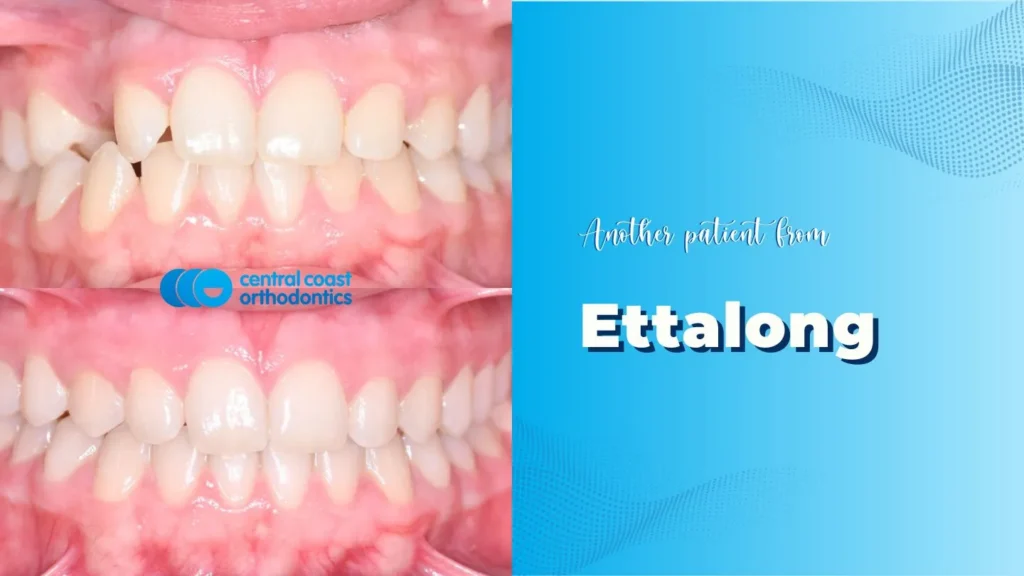 Before and after photographs of a Central Coast Orthodontics patient's teeth, labelled Ettalong