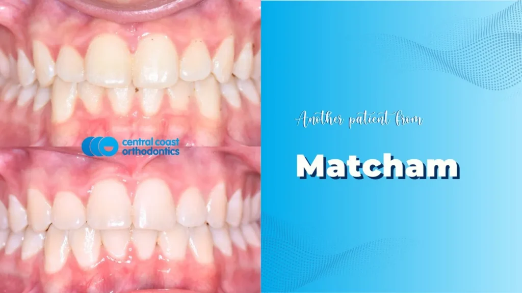 Before and after photographs of a Central Coast Orthodontics patient's teeth, labelled Matcham