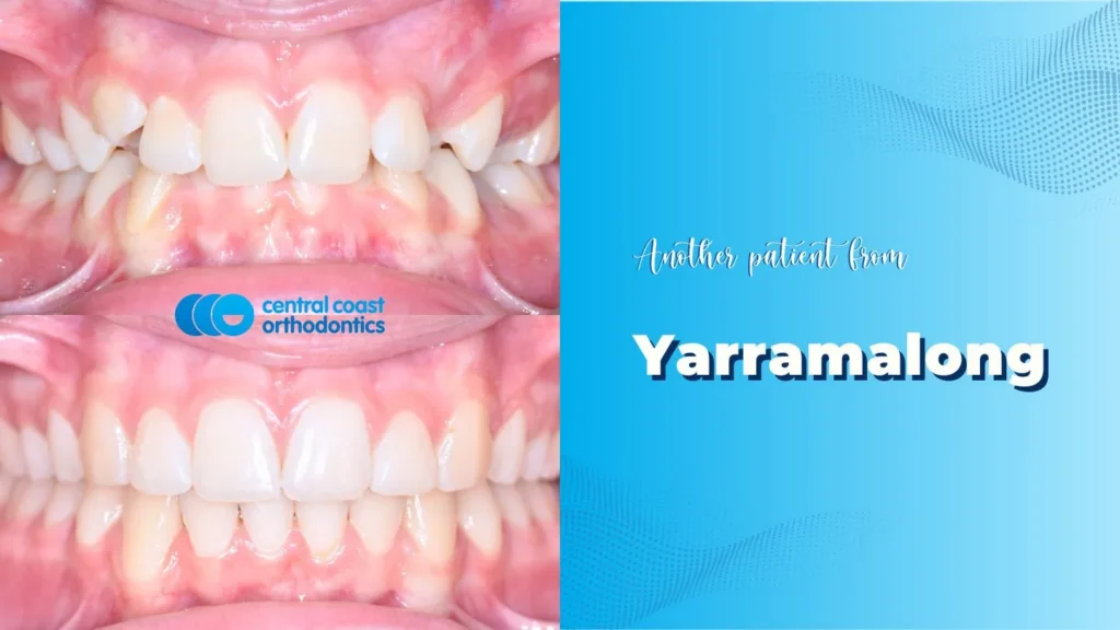 Before and after photographs of a Central Coast Orthodontics patient's teeth, labelled Yarramalong