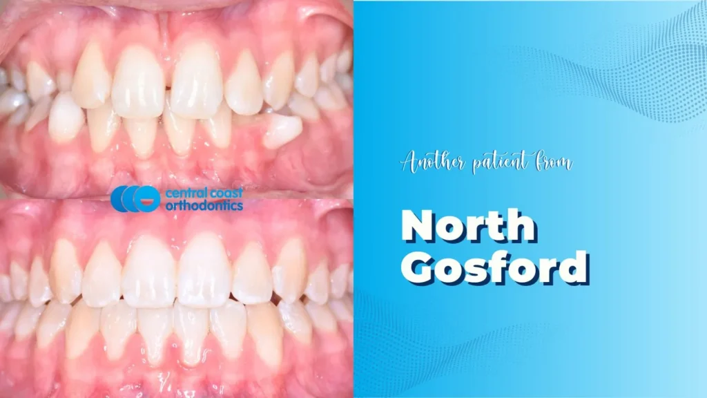 Before and after photographs of a Central Coast Orthodontics patient's teeth, labelled North Gosford
