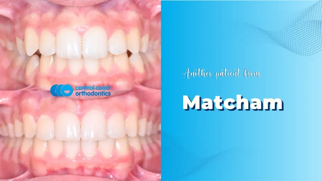 Before and after photographs of a Central Coast Orthodontics patient's teeth, labelled Matcham