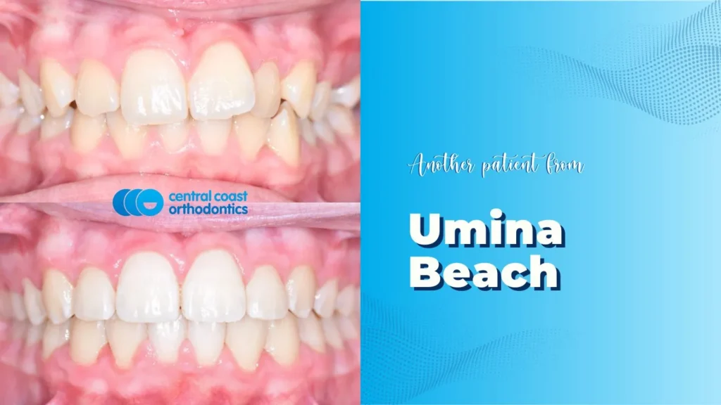 Before and after photographs of a Central Coast Orthodontics patient's teeth, labelled Umina Beach