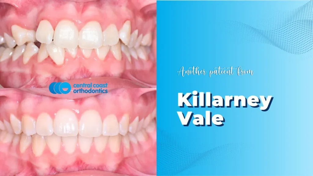 Before and after photographs of a Central Coast Orthodontics patient's teeth, labelled Killarney Vale