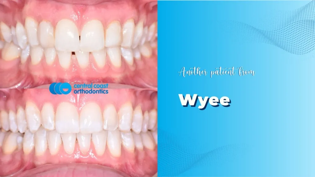 Before and after photographs of a Central Coast Orthodontics patient's teeth, labelled Wyee