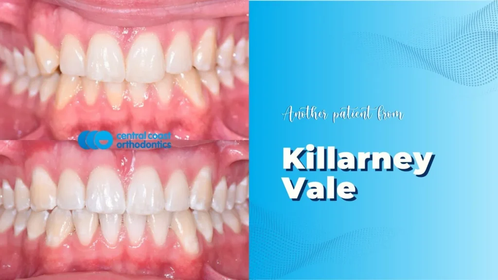Before and after photographs of a Central Coast Orthodontics patient's teeth, labelled Killarney Vale