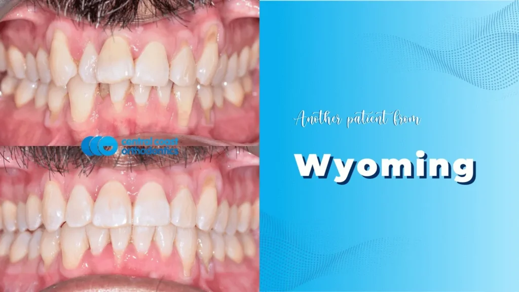Central Coast Orthodontics Wyoming Smile Makeover
