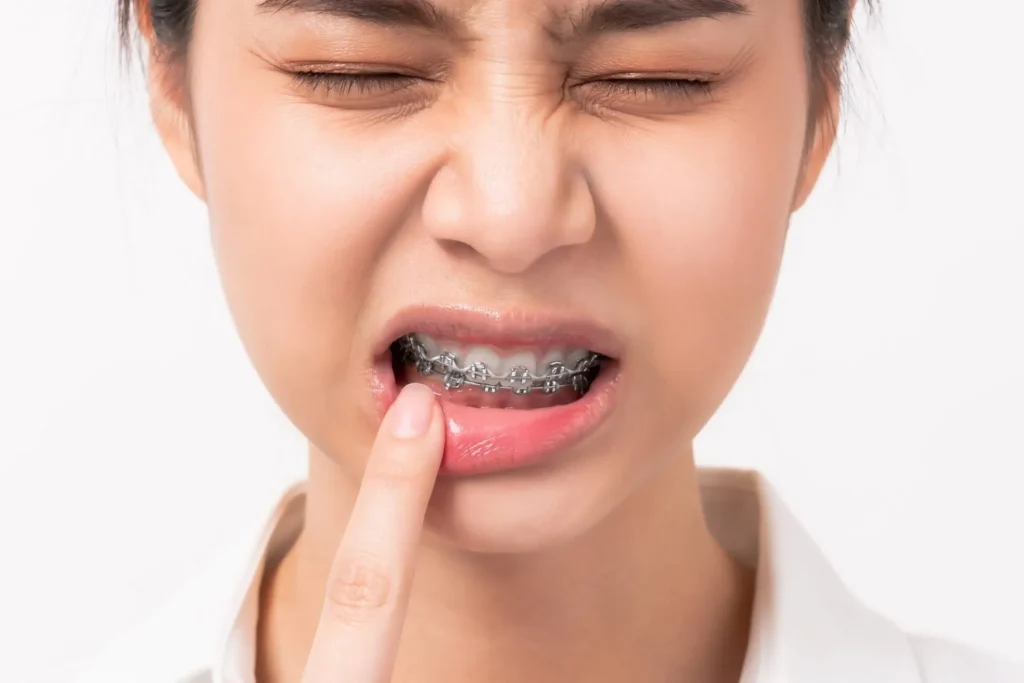 Prepare for Discomfort in your Braces in Central Coast Orthodontics at Gosford, Erina, Central Coast