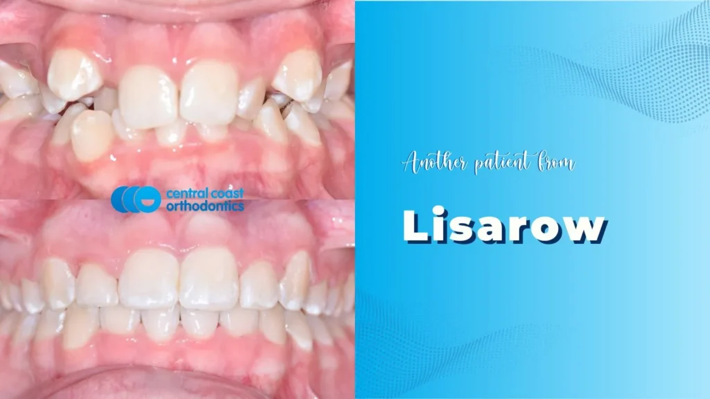 Before and after photographs of a Central Coast Orthodontics patient's teeth, labelled Lisarow