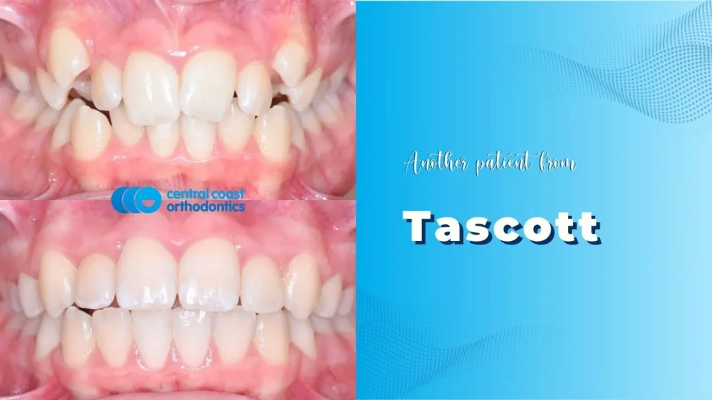 Before and after photographs of a Central Coast Orthodontics patient's teeth, labelled Tascott