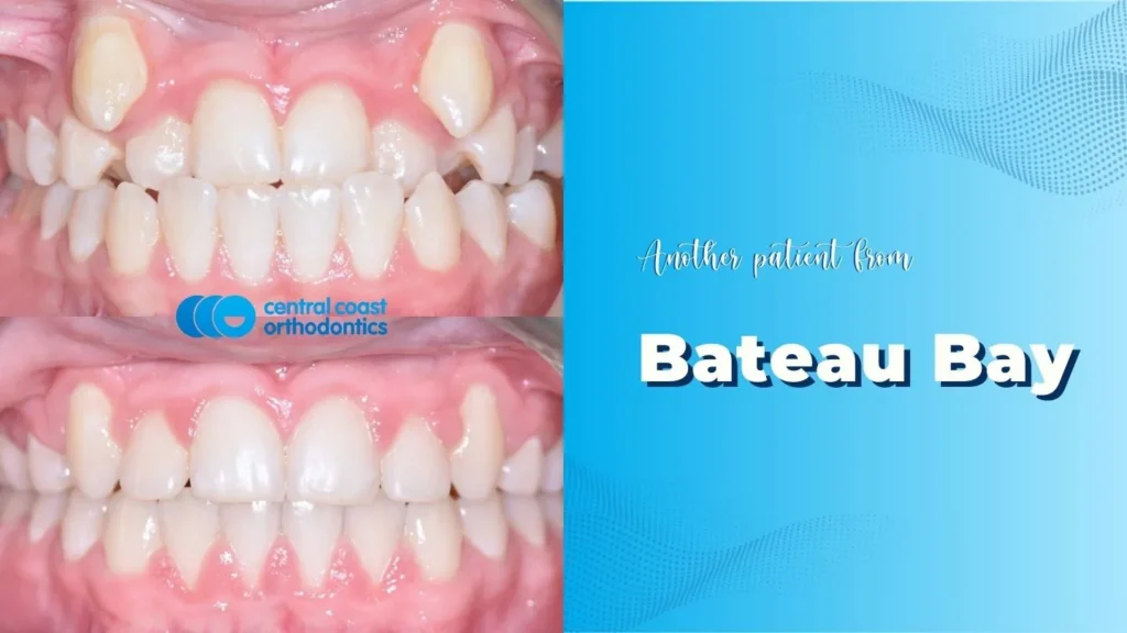 Before and after photographs of a Central Coast Orthodontics patient's teeth, labelled Bateau Bay