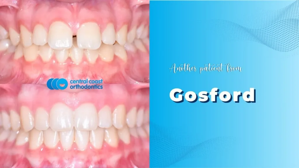 Before and after photographs of a Central Coast Orthodontics patient's teeth, labelled Gosford