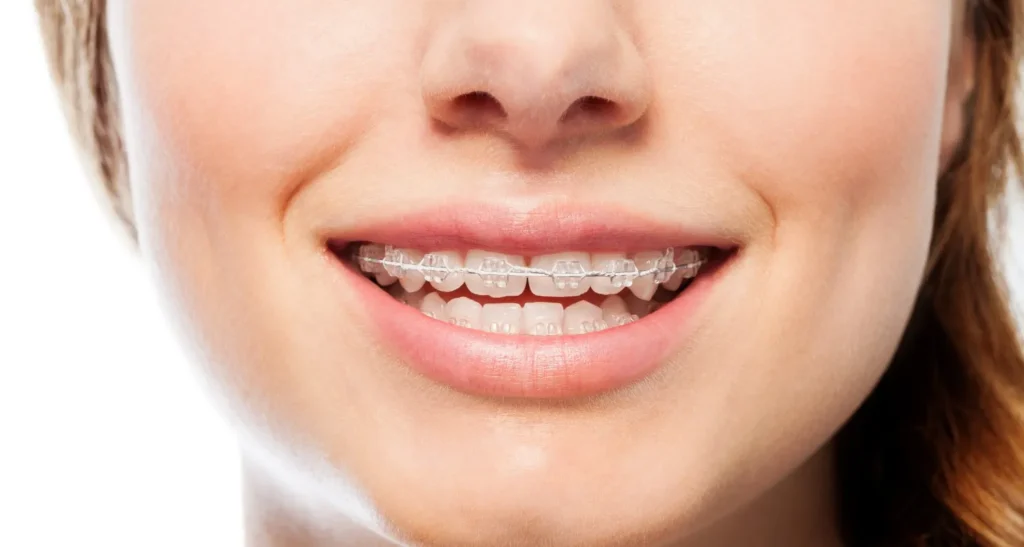 Cost-Effective Orthodontics Gosford | Central Coast Orthodontic
