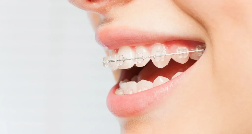 Mixed Braces Options Gosford | Central Coast Orthodontics