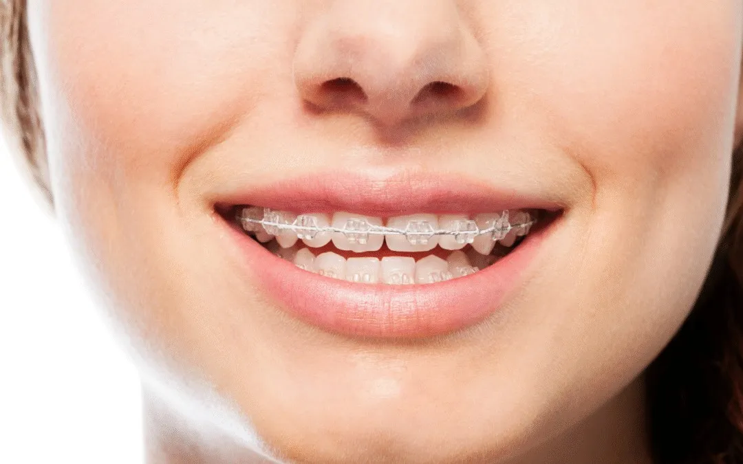 Smart Orthodontic Planning How We Keep Your Family's Budget and Smile Goals Aligned At Central Coast Orthodontics In Gosford, Erina, Central Coast