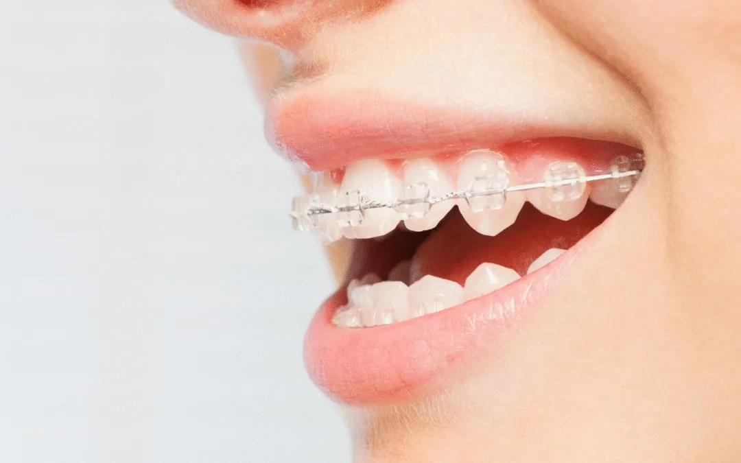 The Best of Both Worlds Why Mixed Braces Might Be Your Perfect Orthodontic Solution At Central Coast Orthodontics In Gosford, Erina, Central Coast