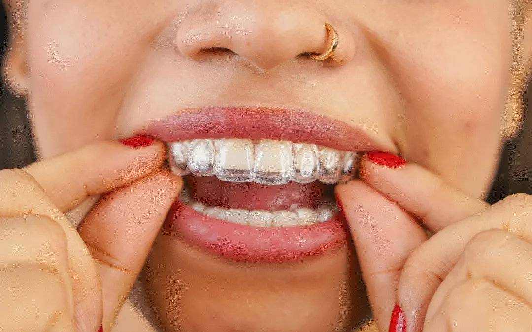 Closing Gaps and Creating Space How Clear Aligners Tackle Your Trickiest Tooth Troubles At Central Coast Orthodontics In Gosford, Erina, Central Coast
