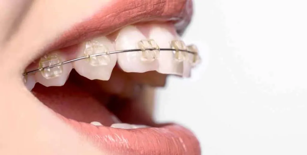 Close-up of clear ceramic braces on the upper front teeth