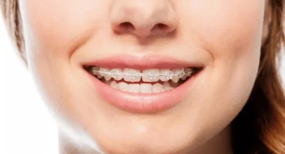 Close-up of a woman's smile wearing tooth-coloured ceramic braces