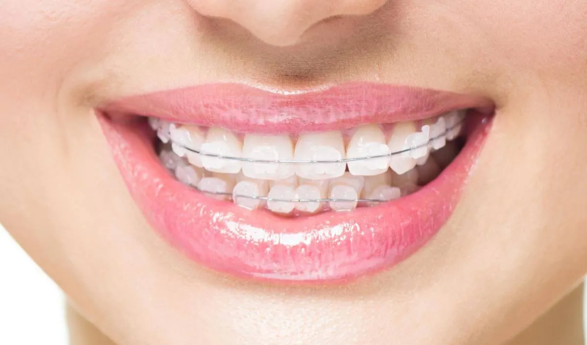 Close-up of a smile with clear ceramic brackets fitted to the upper teeth