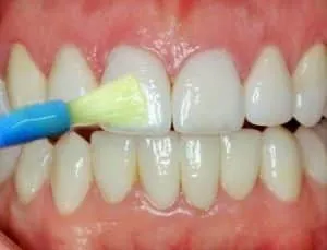 Close-up of a toothbrush with green toothpaste cleaning the front teeth