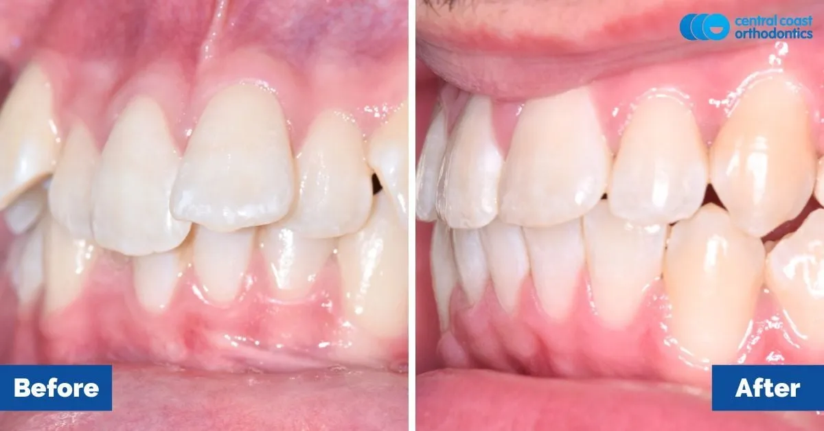 Before and after comparison, side view of the upper and lower teeth