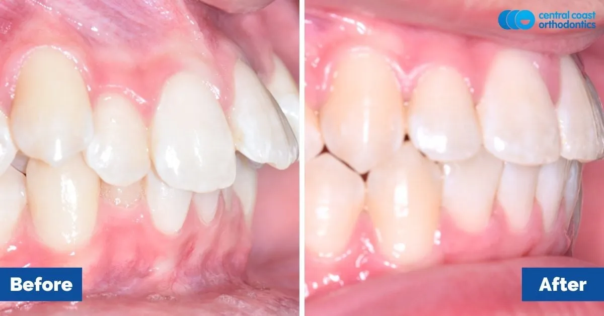 Before and after comparison, front view of the upper and lower teeth