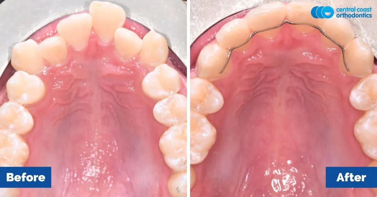 Before and after comparison, upper teeth viewed from below