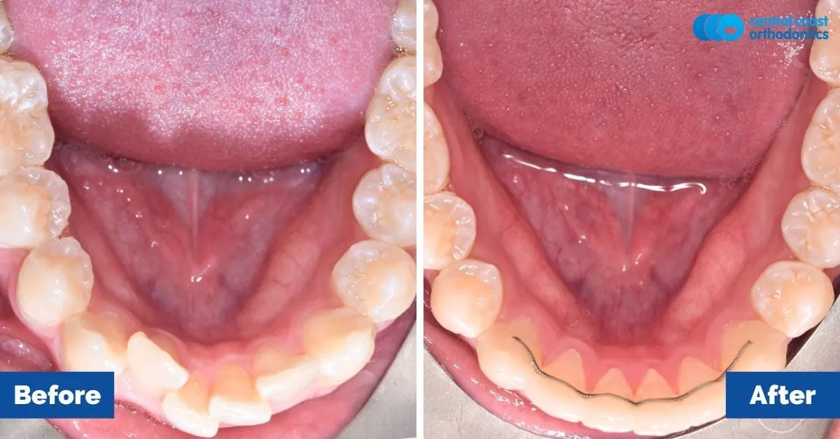 Before and after comparison, lower teeth viewed from above