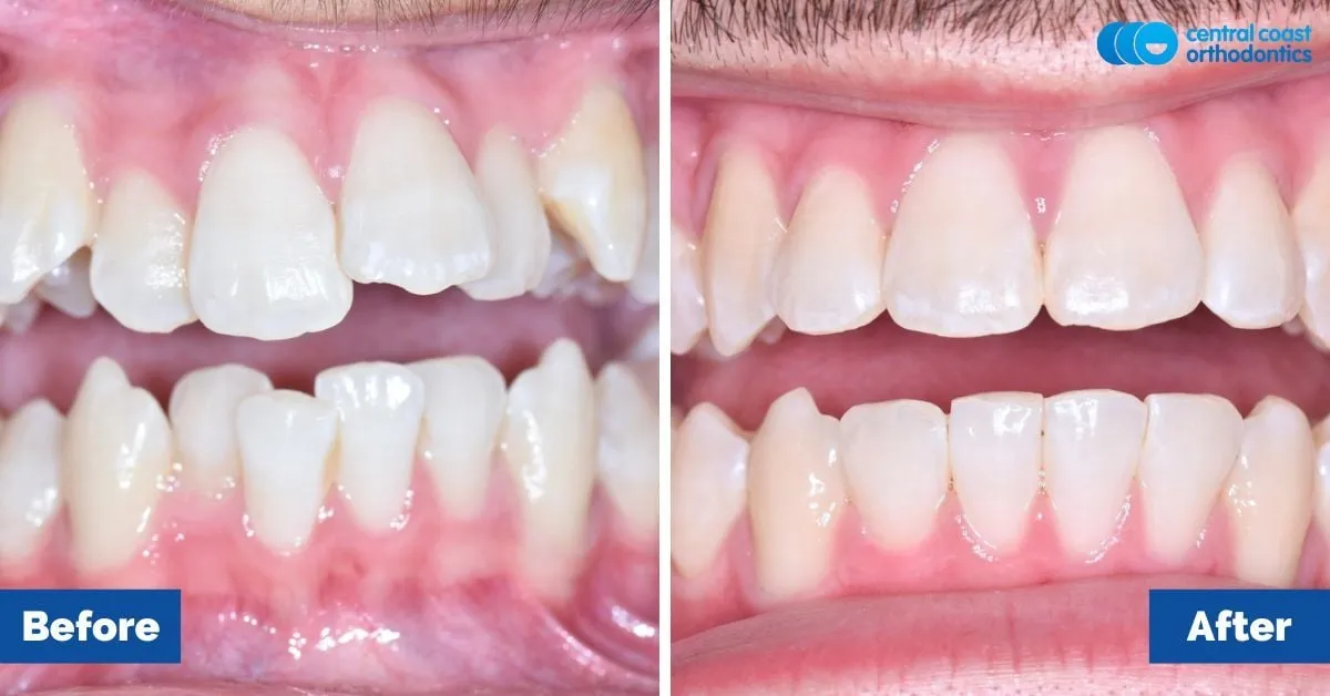 Before and after comparison, front view of the upper and lower teeth