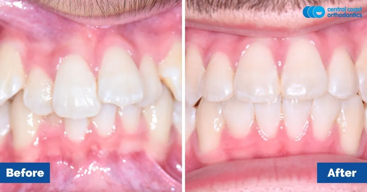 Before and after comparison, front view of the upper and lower teeth