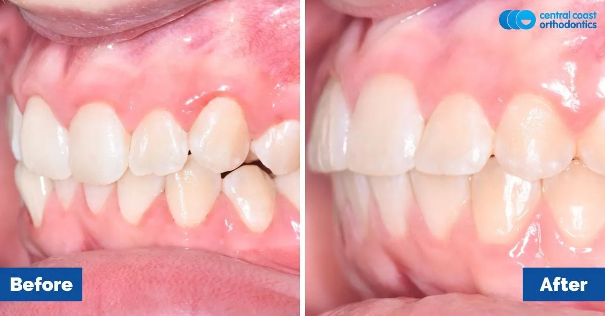 Before and after comparison, front view of the upper and lower teeth