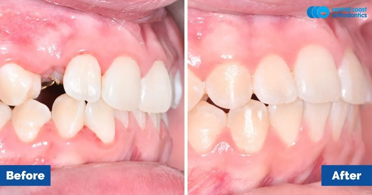 Before and after comparison, side view of the upper and lower teeth