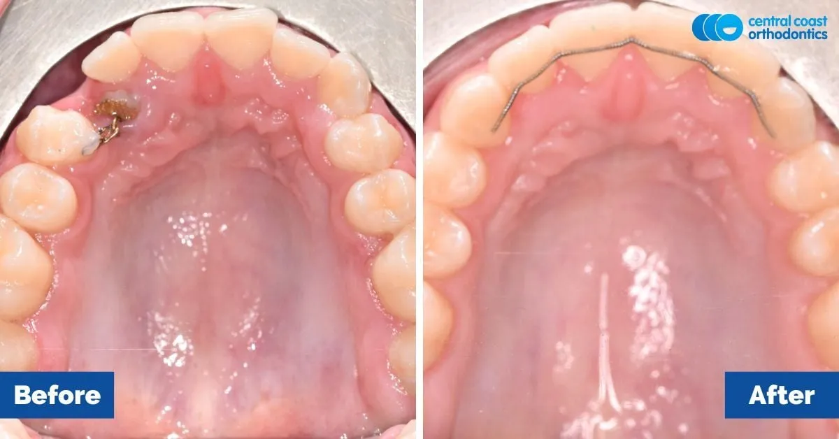 Before and after comparison, upper teeth viewed from below