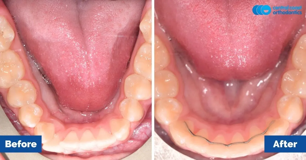 Before and after comparison, lower teeth viewed from above