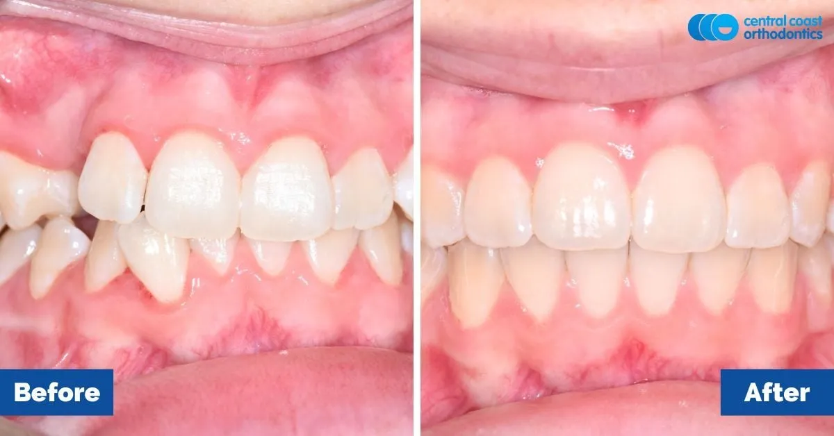 Before and after comparison, front view of the upper and lower teeth