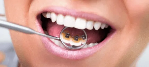 Dental mirror showing a lingual brace fitted behind the upper teeth