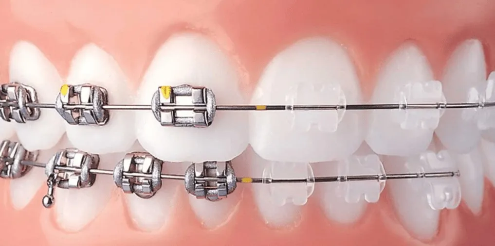 Close-up of braces with coloured elastic ties on the upper and lower teeth
