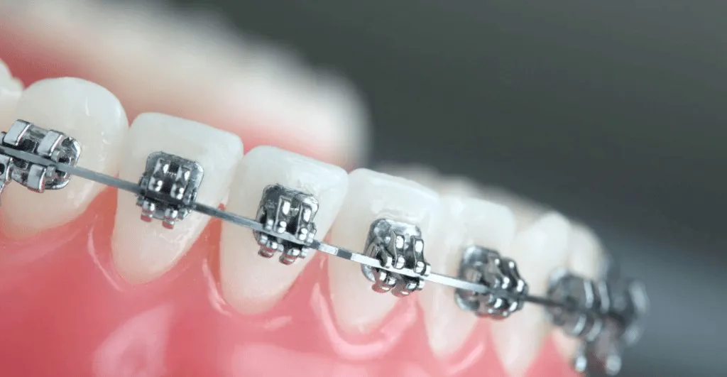 Close-up of metal brackets and archwire fitted along the upper teeth