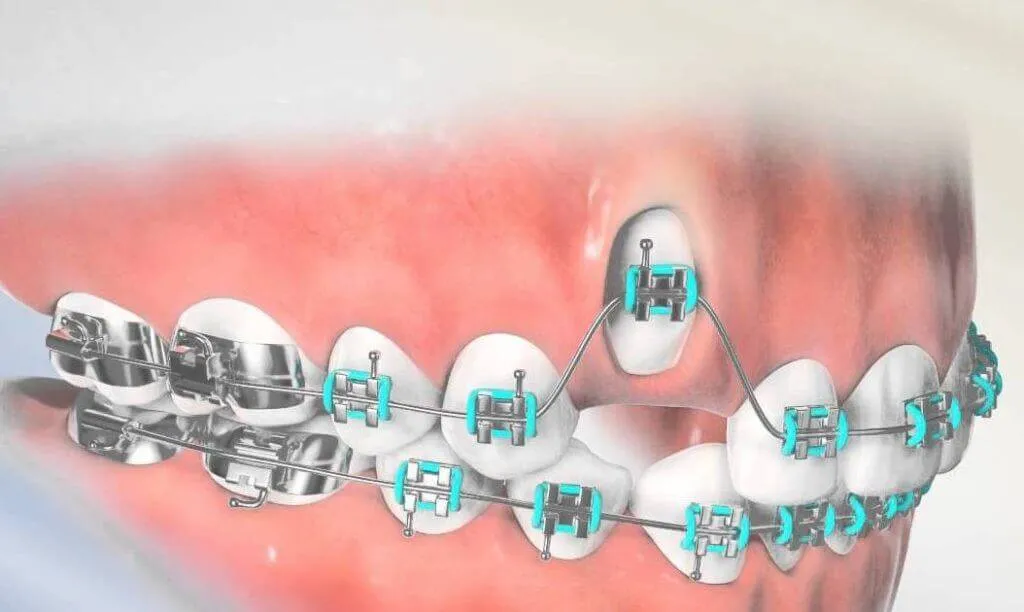 Close-up of braces with green elastic ties fitted along the upper and lower teeth