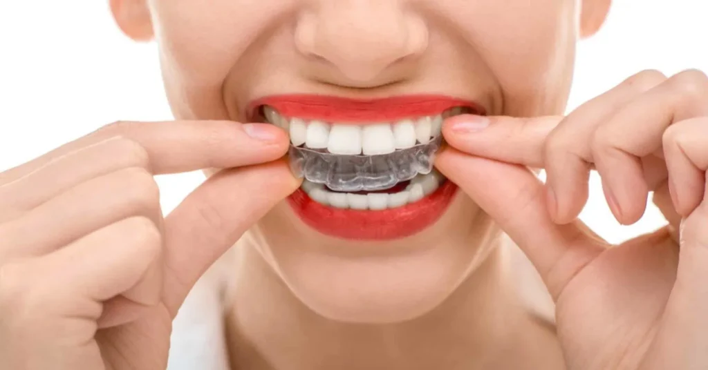 Close-up of a person fitting a clear aligner over their upper teeth